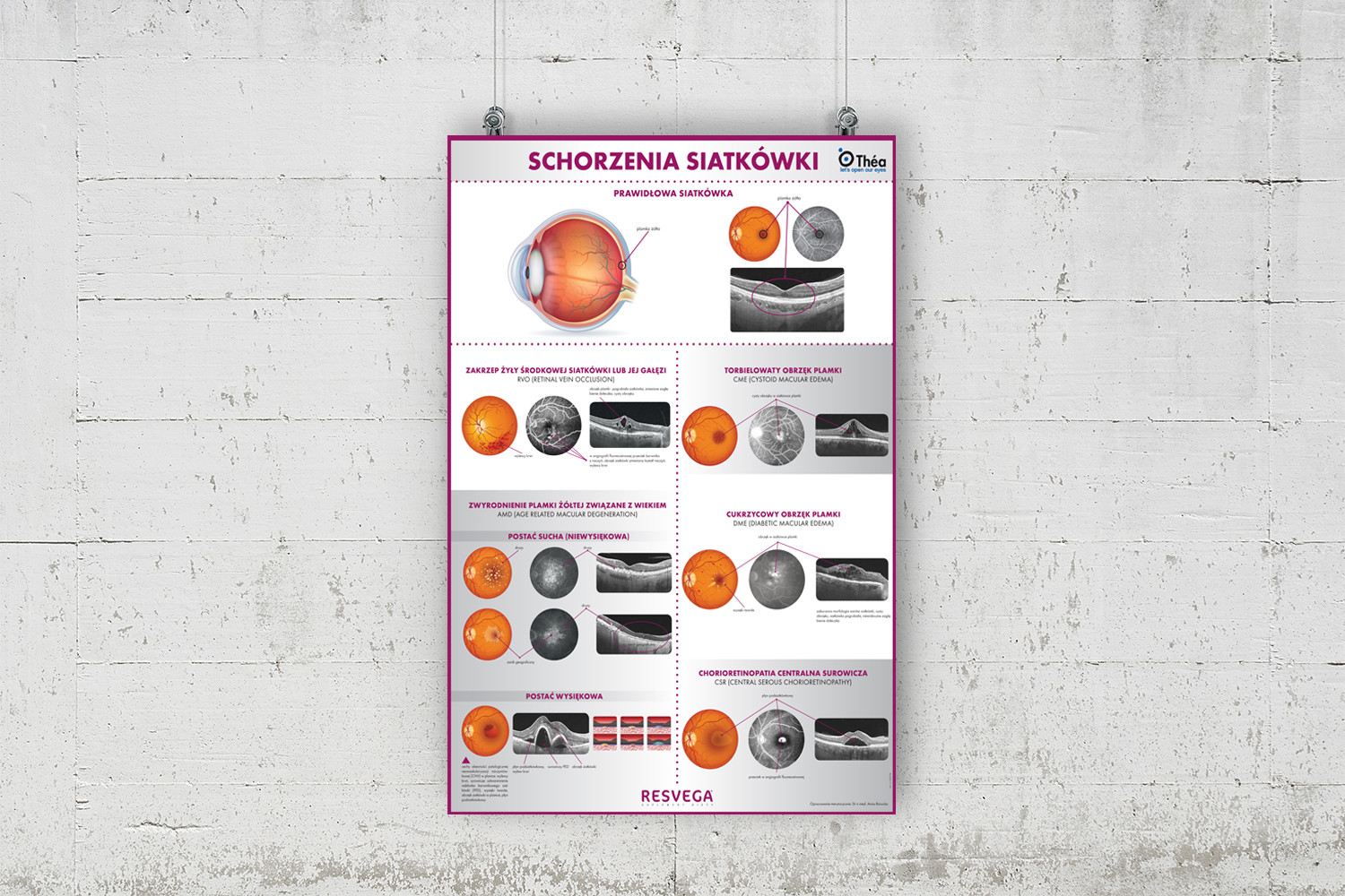 plakat schorzenia siatkowki